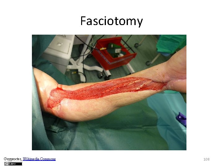 Fasciotomy Guyprocter, Wikimedia Commons 108 
