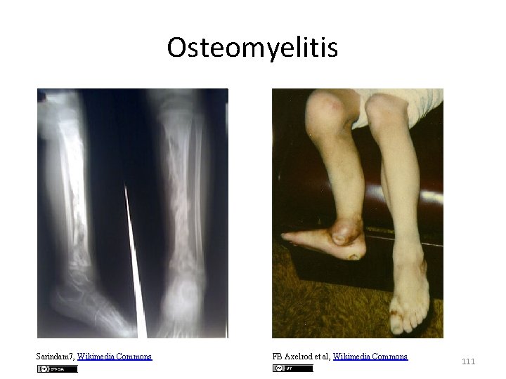 Osteomyelitis Sarindam 7, Wikimedia Commons FB Axelrod et al, Wikimedia Commons 111 