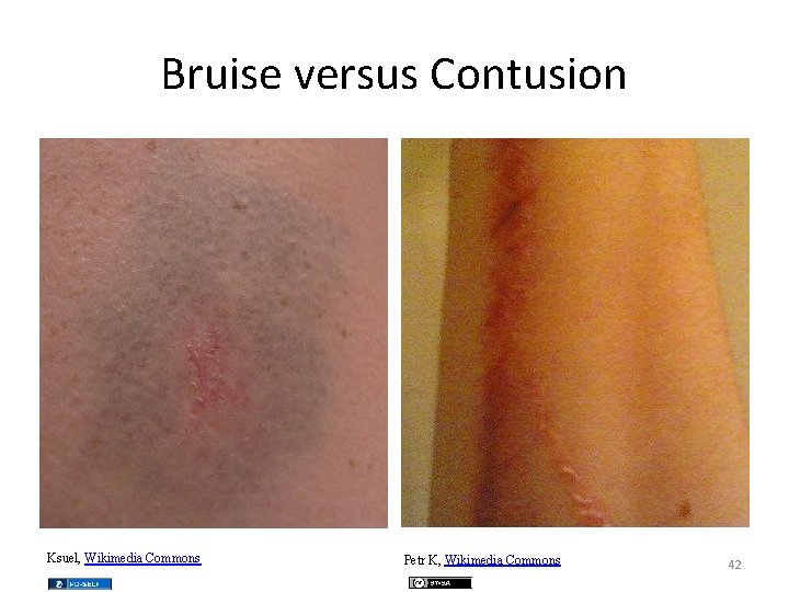 Bruise versus Contusion Ksuel, Wikimedia Commons Petr K, Wikimedia Commons 42 