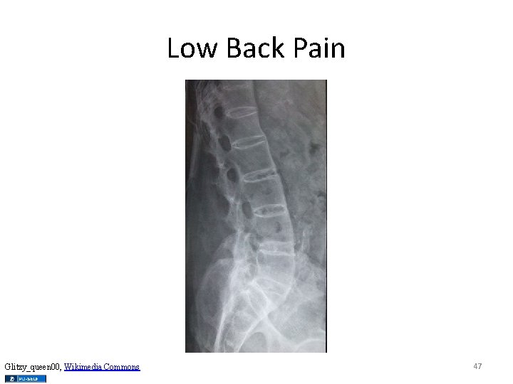 Low Back Pain Glitzy_queen 00, Wikimedia Commons 47 