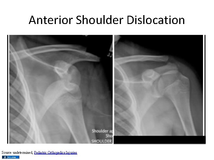 Anterior Shoulder Dislocation Source undetermined, Pediatric Orthopedics Injuries 