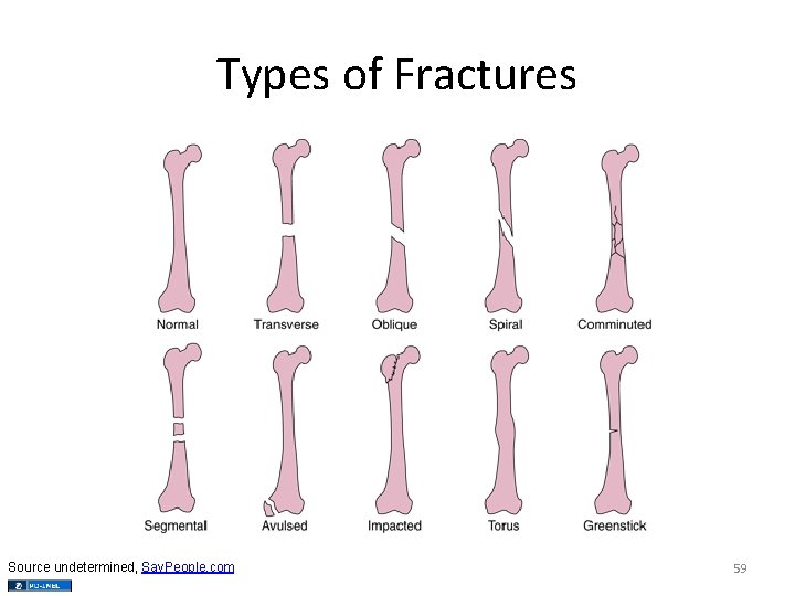 Types of Fractures Source undetermined, Say. People. com 59 