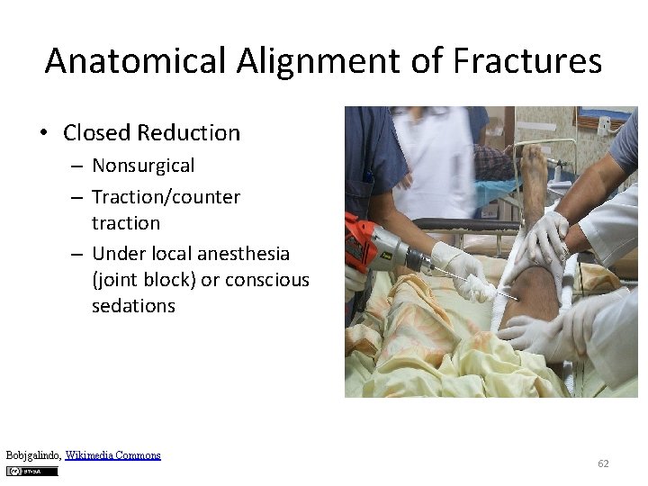 Anatomical Alignment of Fractures • Closed Reduction – Nonsurgical – Traction/counter traction – Under
