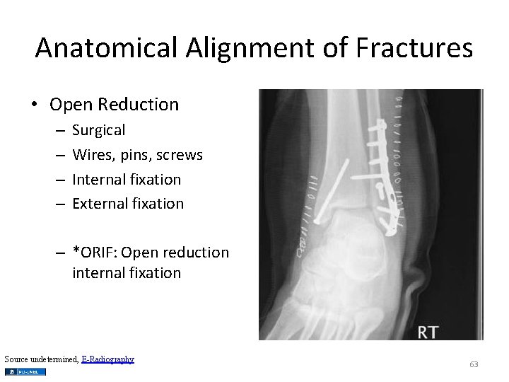 Anatomical Alignment of Fractures • Open Reduction – – Surgical Wires, pins, screws Internal