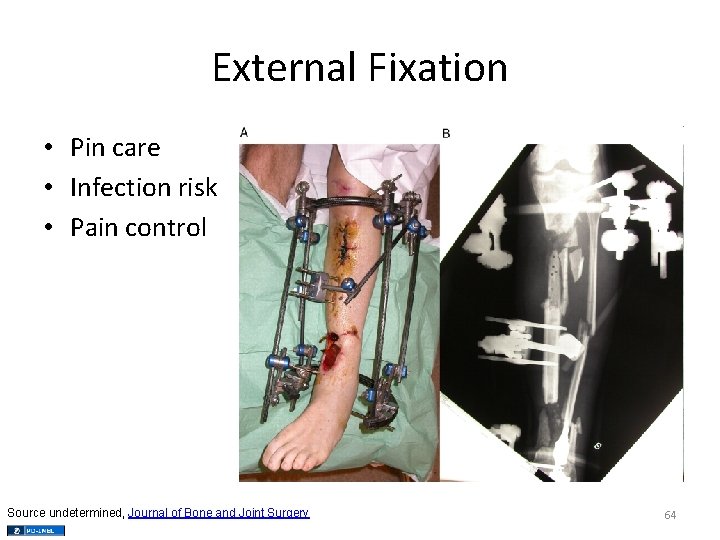 External Fixation • Pin care • Infection risk • Pain control Source undetermined, Journal