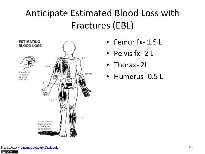 Anticipate Estimated Blood Loss with Fractures (EBL) • • Hugh Dudley, Primary Surgery Textbook