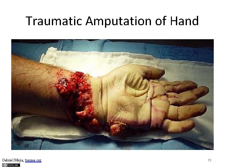Traumatic Amputation of Hand Gabriel Mejia, trauma. org 78 