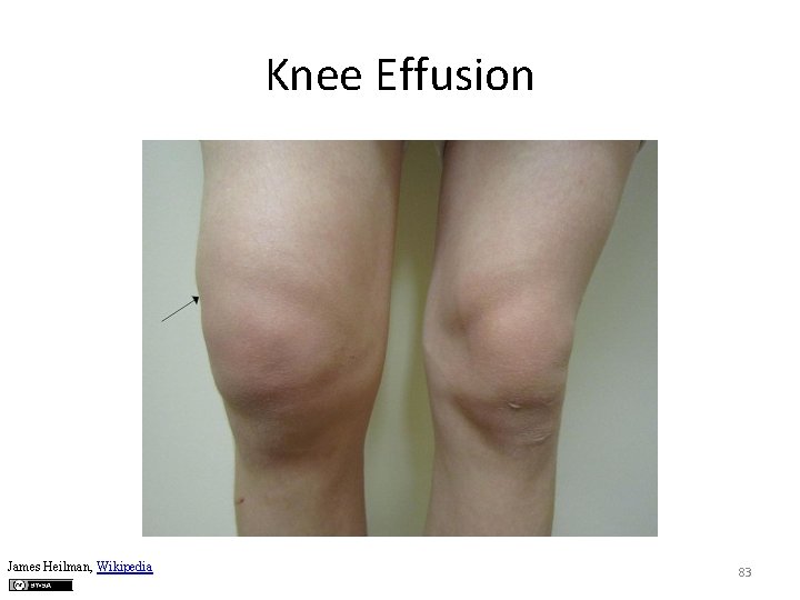 Knee Effusion James Heilman, Wikipedia 83 