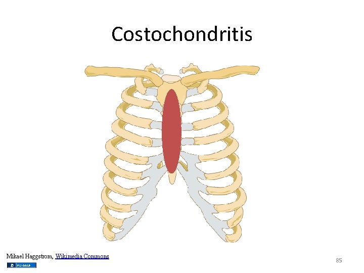 Costochondritis Mikael Haggstrom, Wikimedia Commons 85 