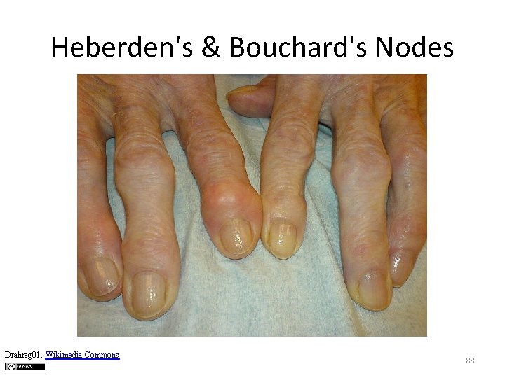 Heberden's & Bouchard's Nodes Drahreg 01, Wikimedia Commons 88 