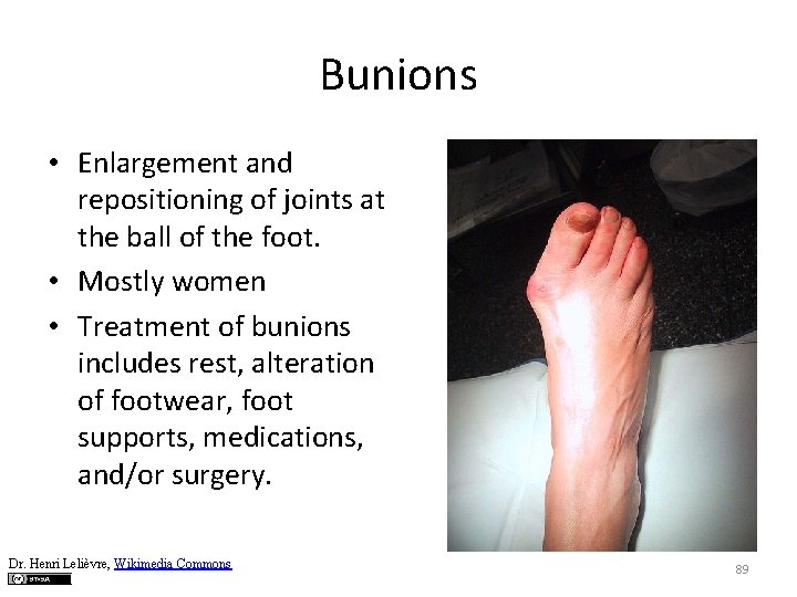 Bunions • Enlargement and repositioning of joints at the ball of the foot. •