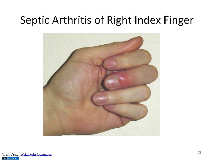Septic Arthritis of Right Index Finger Chris Craig, Wikimedia Commons 93 