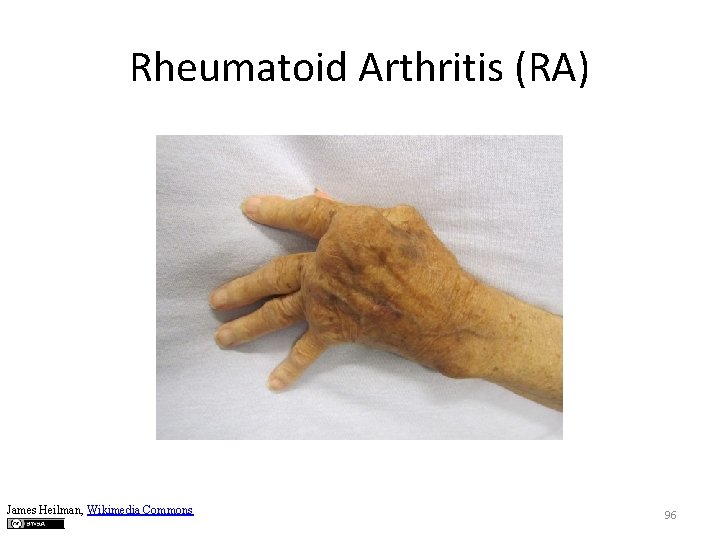 Rheumatoid Arthritis (RA) James Heilman, Wikimedia Commons 96 