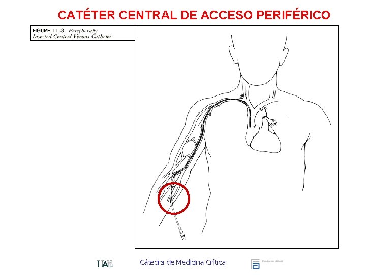 CATÉTER CENTRAL DE ACCESO PERIFÉRICO Cátedra de Medicina Crítica 