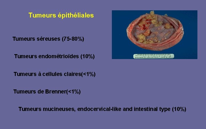 Tumeurs épithéliales Tumeurs séreuses (75 -80%) Tumeurs endométrioïdes (10%) Tumeurs à cellules claires(<1%) Tumeurs