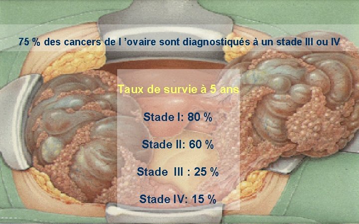 75 % des cancers de l ’ovaire sont diagnostiqués à un stade III ou