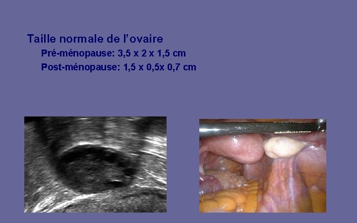 Taille normale de l’ovaire Pré-ménopause: 3, 5 x 2 x 1, 5 cm Post-ménopause: