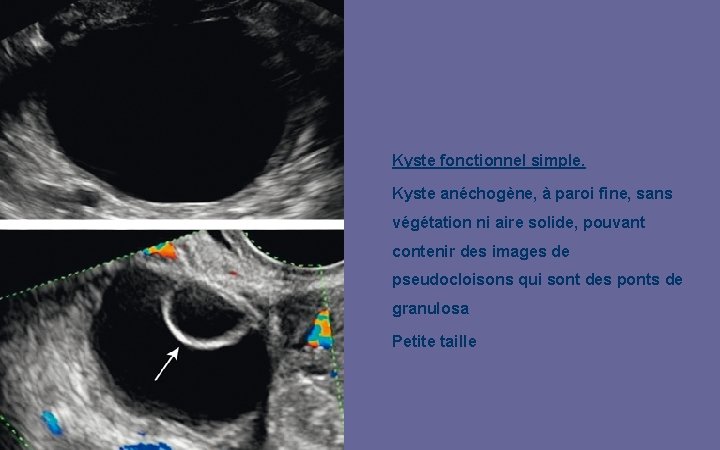 Kyste fonctionnel simple. Kyste anéchogène, à paroi fine, sans végétation ni aire solide, pouvant