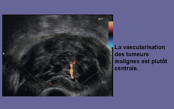 La vascularisation des tumeurs malignes est plutôt centrale. 