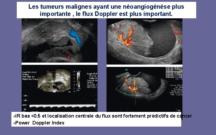 Les tumeurs malignes ayant une néoangiogénèse plus importante , le flux Doppler est plus