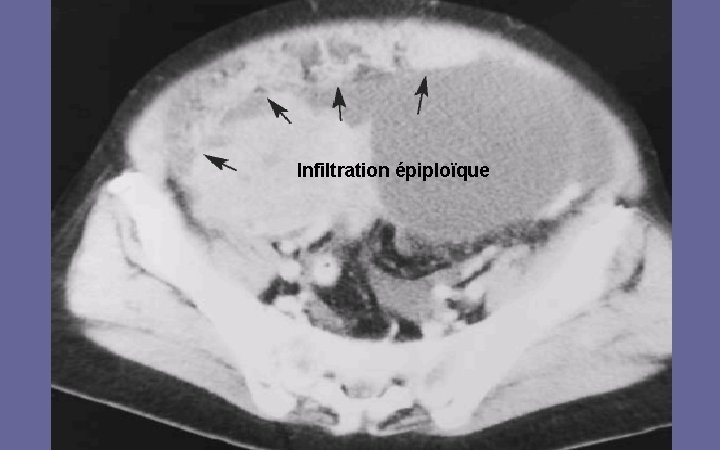 Infiltration épiploïque 