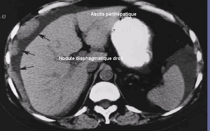 Ascite périhépatique Nodule diaphagmatique droit 