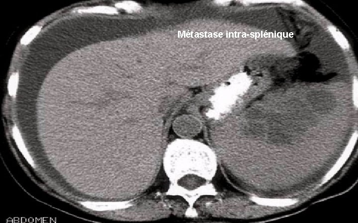 Métastase intra-splénique 