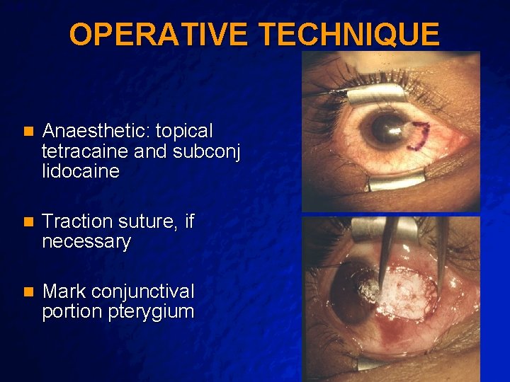 Slide 10 © 2003 By Default! OPERATIVE TECHNIQUE n Anaesthetic: topical tetracaine and subconj