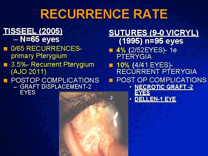 Slide 29 © 2003 By Default! RECURRENCE RATE TISSEEL (2005) – N=65 eyes 0/65
