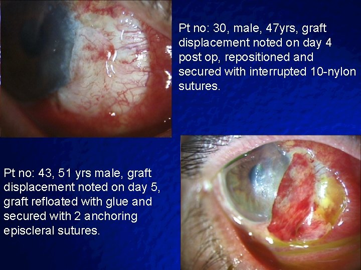 Slide 31 © 2003 By Default! Pt no: 30, male, 47 yrs, graft displacement