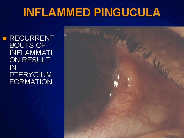 Slide 6 © 2003 By Default! INFLAMMED PINGUCULA n RECURRENT BOUTS OF INFLAMMATI ON