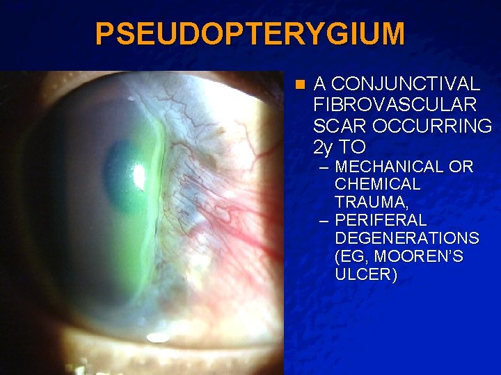 Slide 7 © 2003 By Default! PSEUDOPTERYGIUM n A CONJUNCTIVAL FIBROVASCULAR SCAR OCCURRING 2