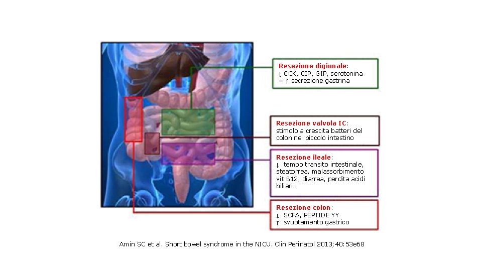 Resezione digiunale: ↓ CCK, CIP, GIP, serotonina = ↑ secrezione gastrina Resezione valvola IC: