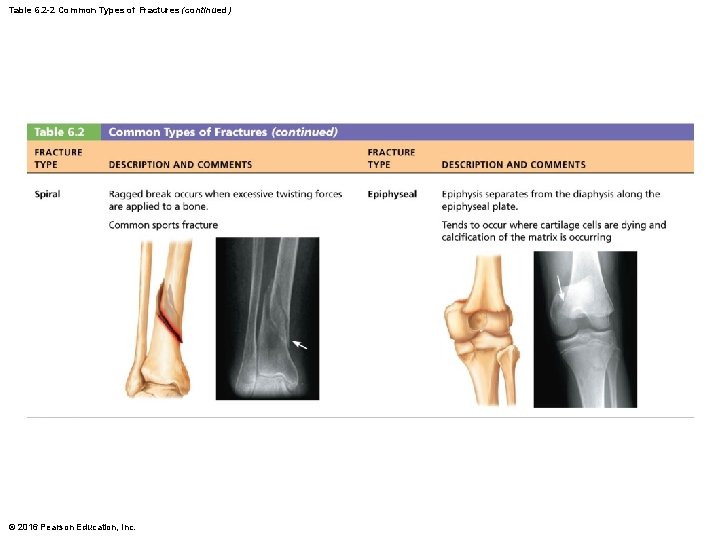 Table 6. 2 -2 Common Types of Fractures (continued) © 2016 Pearson Education, Inc.