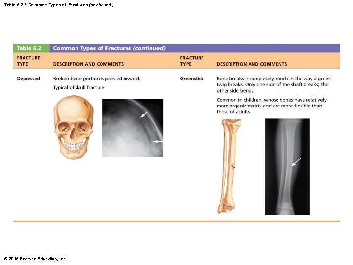 Table 6. 2 -3 Common Types of Fractures (continued) © 2016 Pearson Education, Inc.