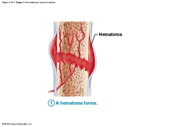 Figure 6. 14 -1 Stages in the healing of a bone fracture. Hematoma 1