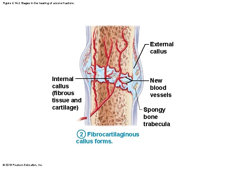 Figure 6. 14 -2 Stages in the healing of a bone fracture. External callus