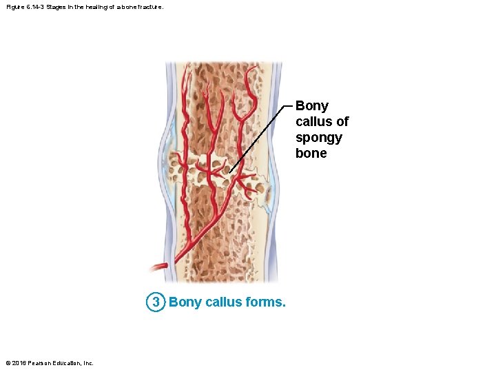 Figure 6. 14 -3 Stages in the healing of a bone fracture. Bony callus