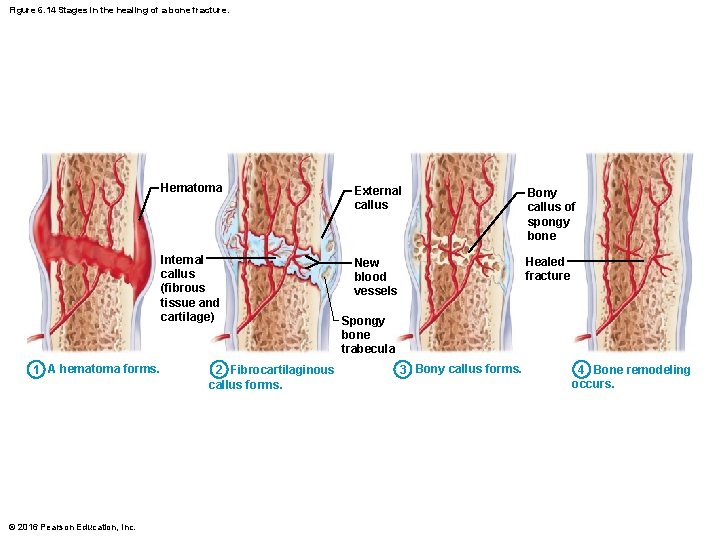 Figure 6. 14 Stages in the healing of a bone fracture. 1 A hematoma