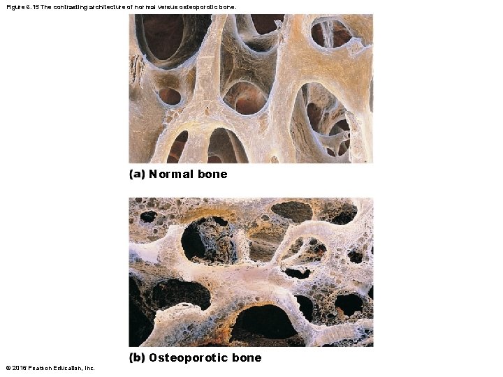 Figure 6. 15 The contrasting architecture of normal versus osteoporotic bone. Normal bone ©