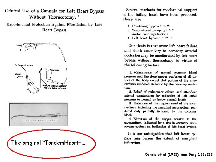 The original “Tandem. Heart”… Dennis et al (1962) Ann Surg 156: 623 