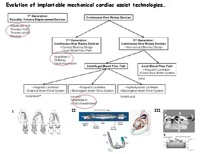 Evolution of implantable mechanical cardiac assist technologies… … I II III 