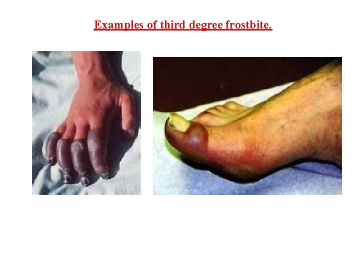 Examples of third degree frostbite. 