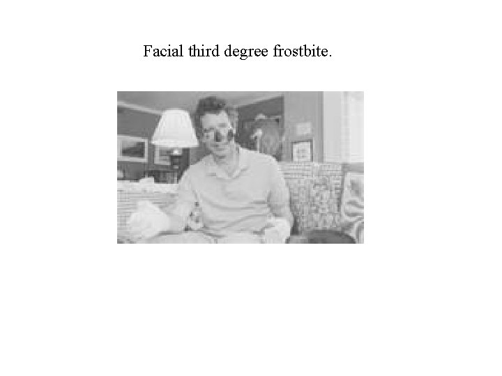 Facial third degree frostbite. 