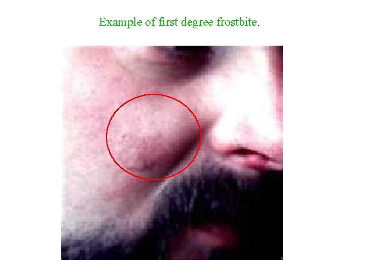 Example of first degree frostbite. 