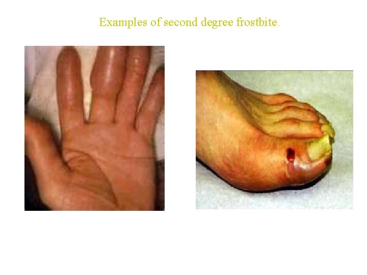 Examples of second degree frostbite. 