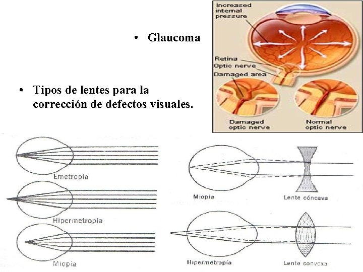  • Glaucoma • Tipos de lentes para la corrección de defectos visuales. Glaucoma