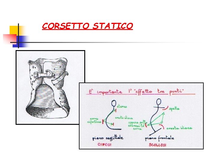 CORSETTO STATICO 