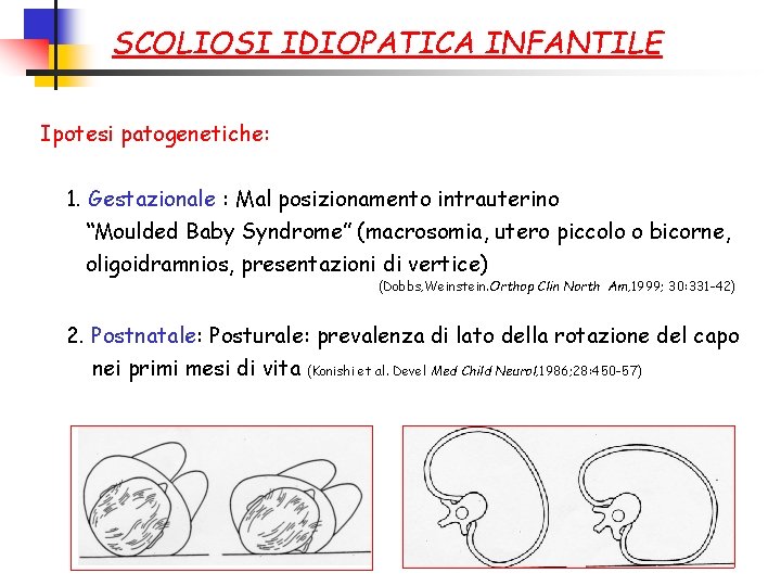 SCOLIOSI IDIOPATICA INFANTILE Ipotesi patogenetiche: 1. Gestazionale : Mal posizionamento intrauterino “Moulded Baby Syndrome”