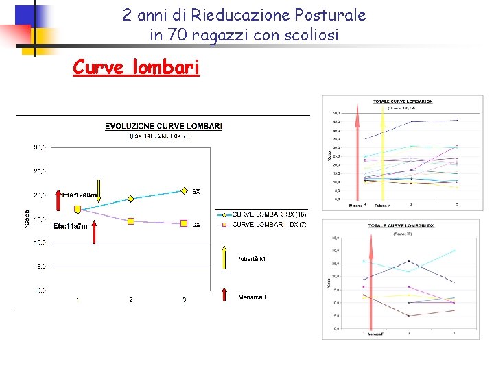 2 anni di Rieducazione Posturale in 70 ragazzi con scoliosi Curve lombari 